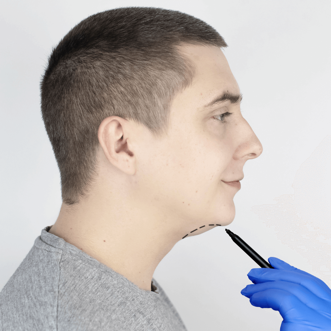 double chin correction